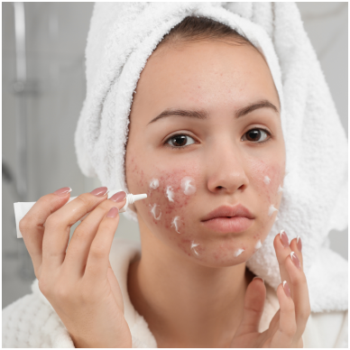 HOW TO PREVENT ADULT ACNE AND CONTROL OILY SKIN: 4 ESSENTIAL TIPS
